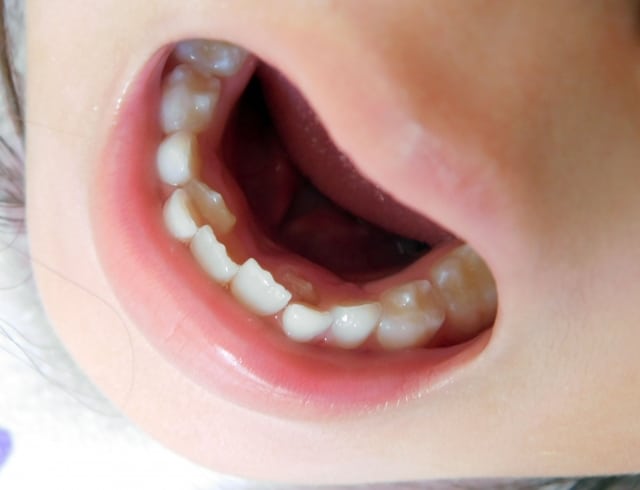 子どもの歯